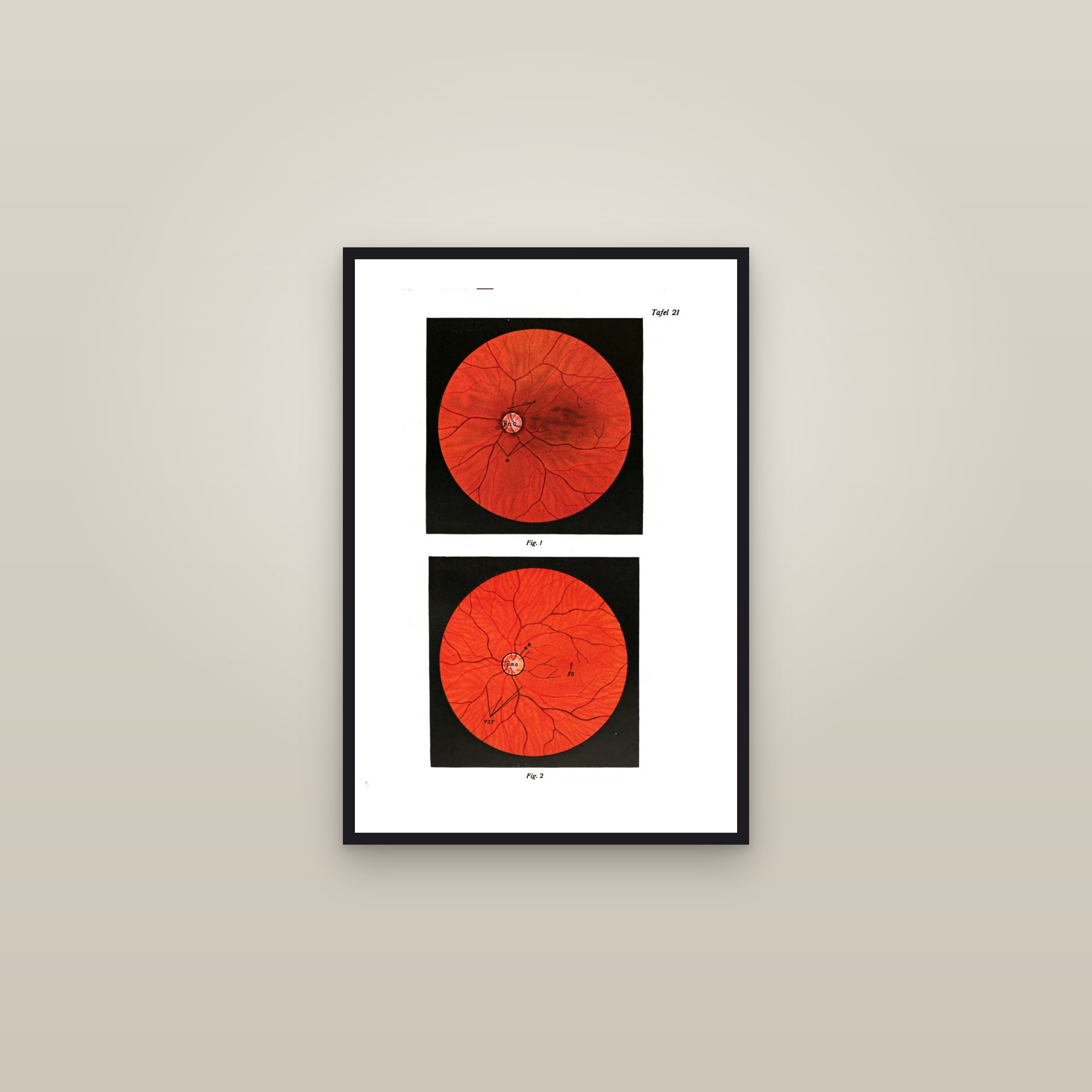 The Retina (fundus of the eye) — framed in a gallery setting