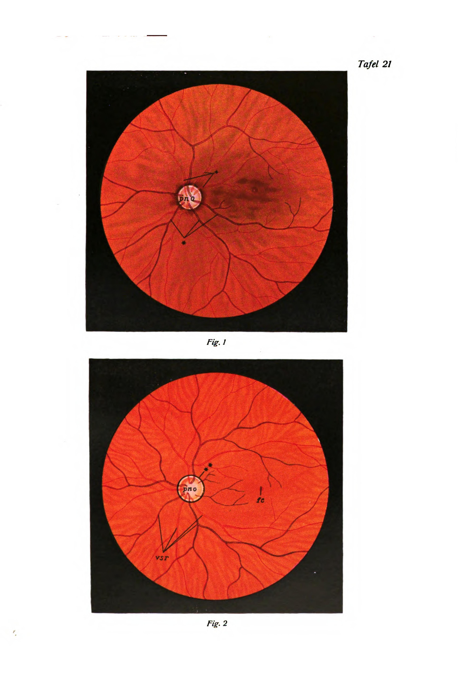 The Retina (fundus of the eye)